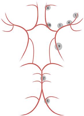 Endovascular Treatment of Intracranial Aneurysms in Small Peripheral Vessel Segments—Efficacy and Intermediate Follow-Up Results of Flow Diversion With the Silk Vista Baby Low-Profile Flow Diverter